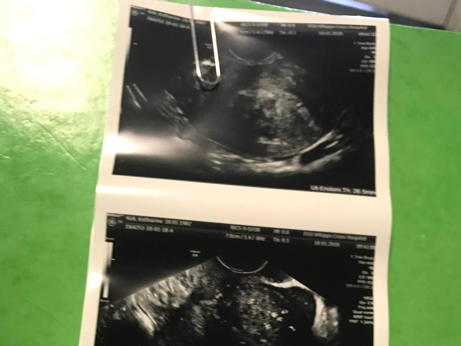 It's not always easy to tell whether you are having a miscarriage in the first trimester of pregnancy. How Do I Know If I Am Having A Miscarriage? Counting To Ten